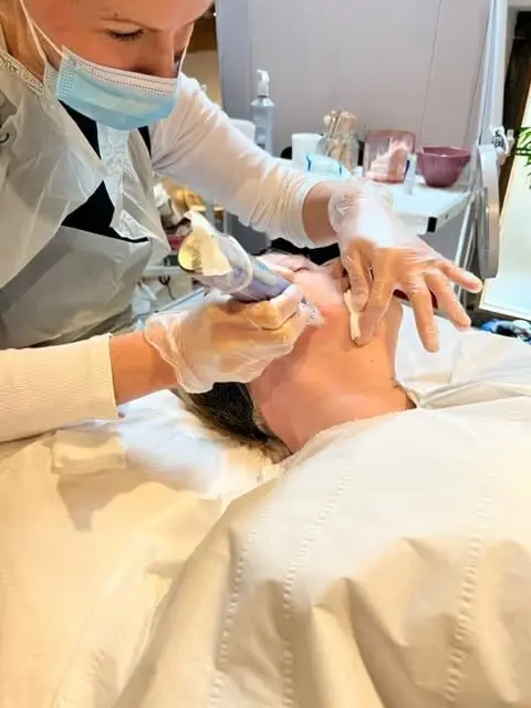 Microneedling
