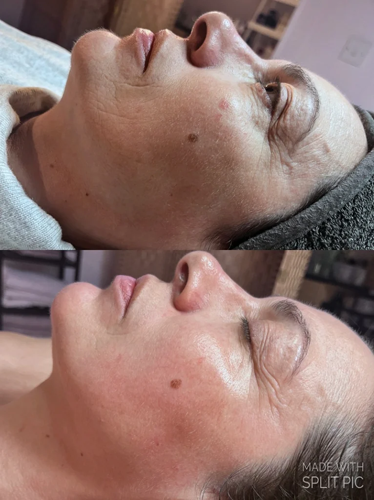 SkinPen